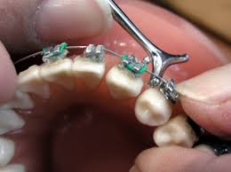 Material de ortodoncista